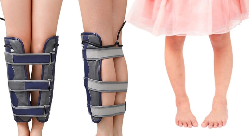 nẹp chân vòng kiềng