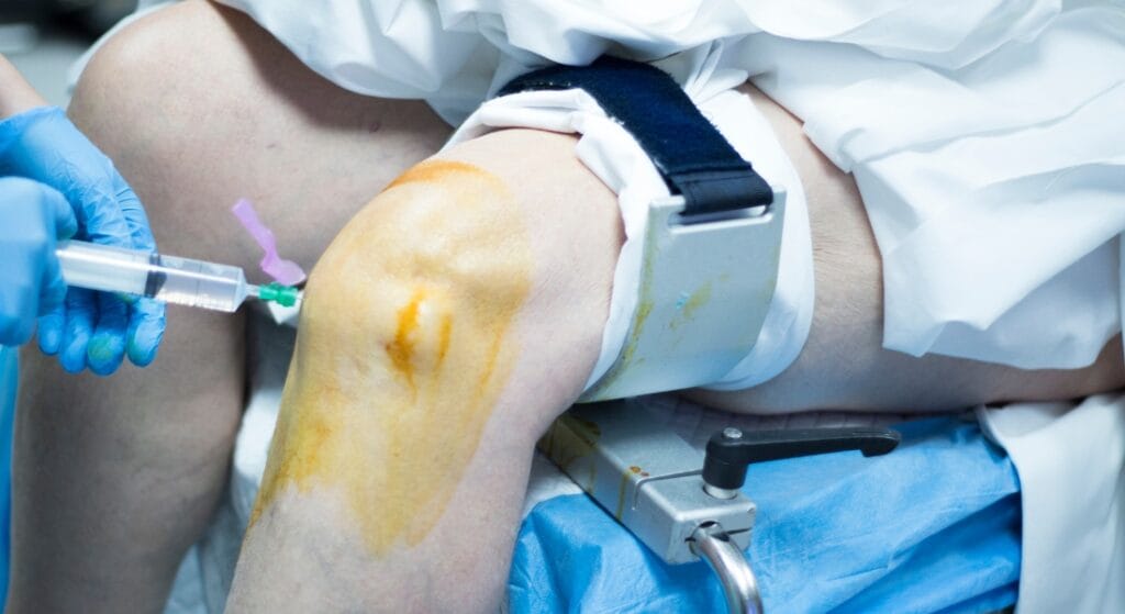 quy trình mổ nội soi khớp gối