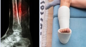 rạn xương có cần bó bột không