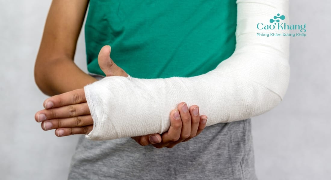 sau khi bó bột tay bị sưng