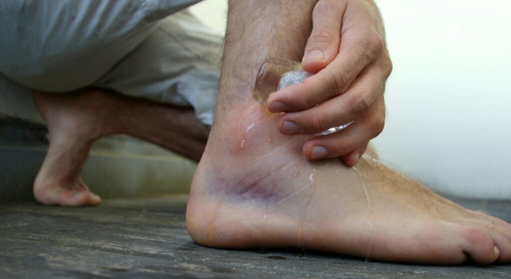 sưng do tràn dịch khớp cổ chân