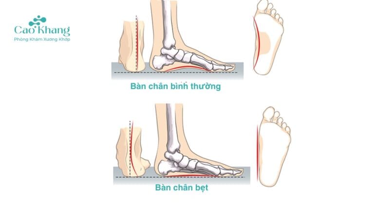 tác hại của bàn chân bẹt