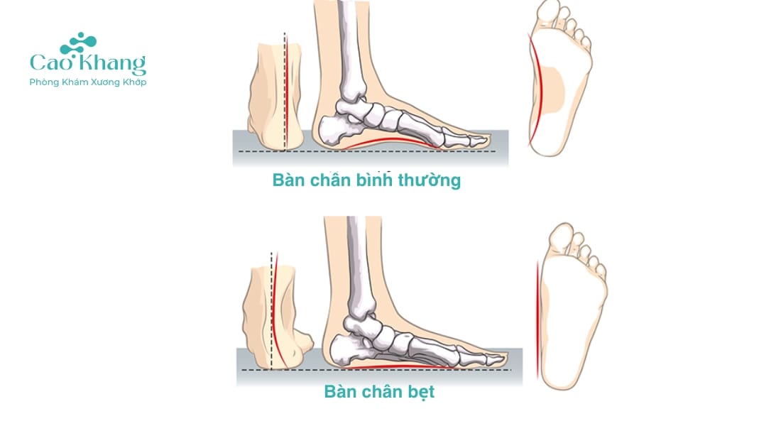 tác hại của bàn chân bẹt