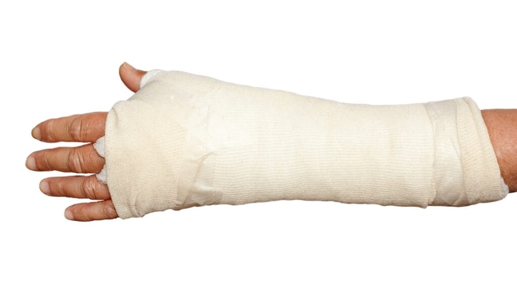 tay bị sưng sau bó bột