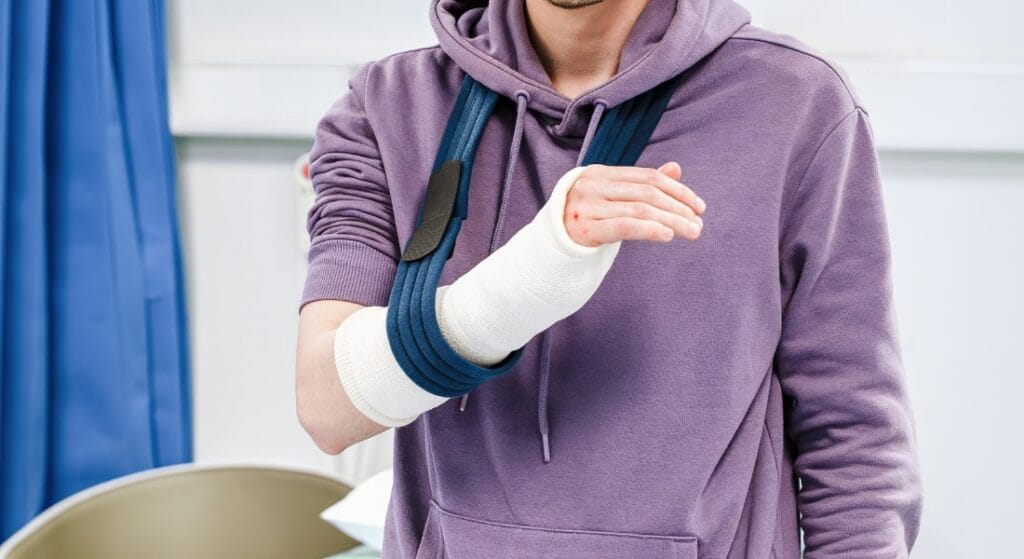 tay sưng sau khi bó bột