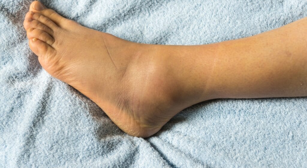 tràn dịch khớp cổ chân 