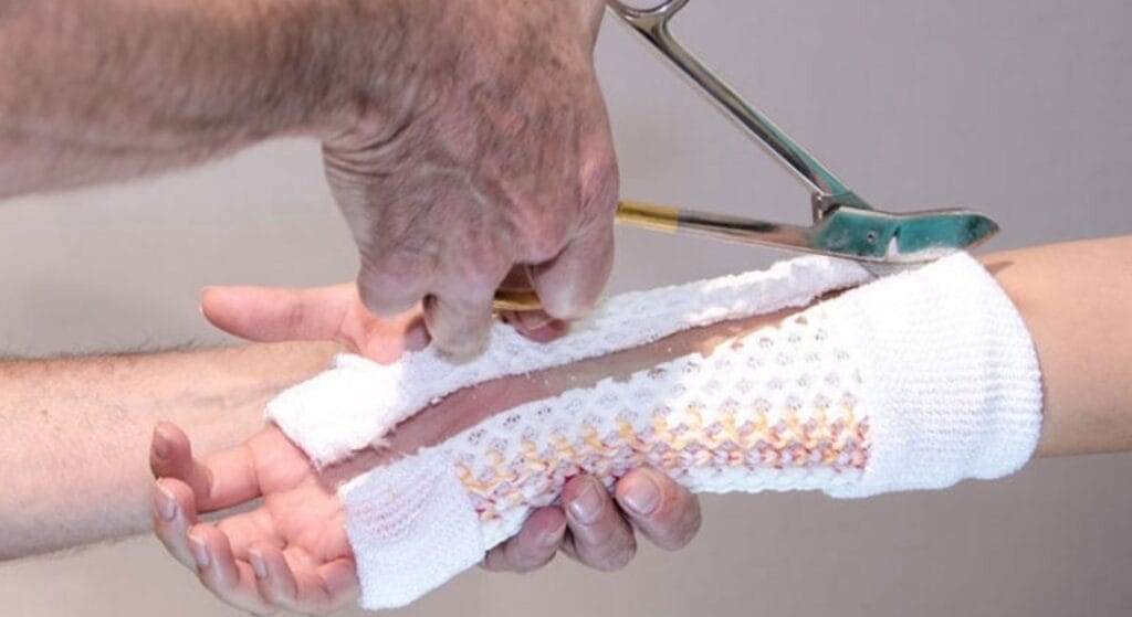 tự tháo bó bột tại nhà