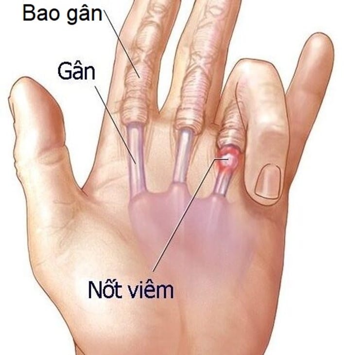 viêm bao gân ngón tay