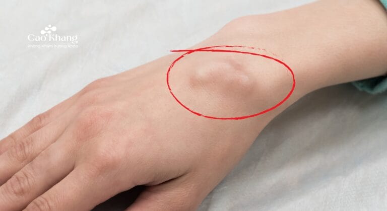 Mẹo chữa u bao hoạt dịch khớp cổ tay