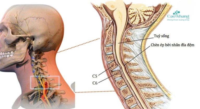 Thoát vị đĩa đệm cổ chèn ép tủy