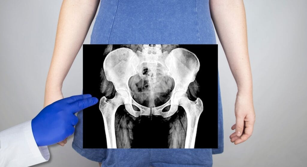 X-quang xương chậu