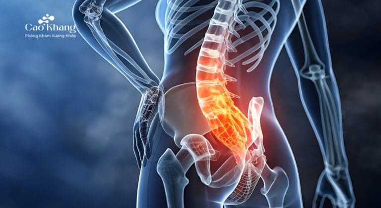 bị võng lưng là gì