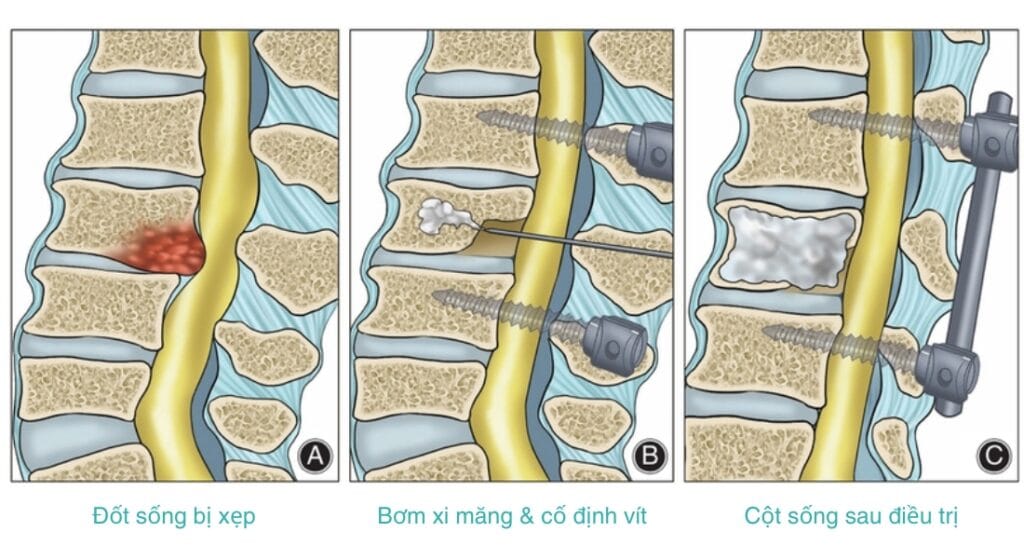 bơm xi măng điều trị xẹp đốt sống