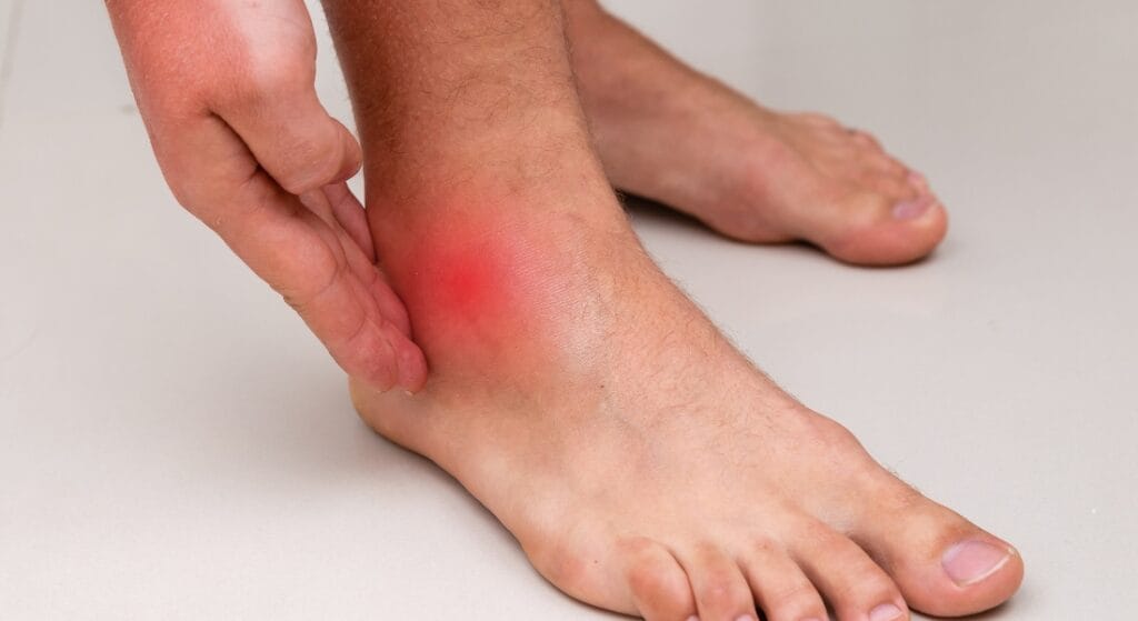 bong gân cổ chân