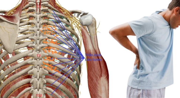 cách chữa đau thần kinh liên sườn