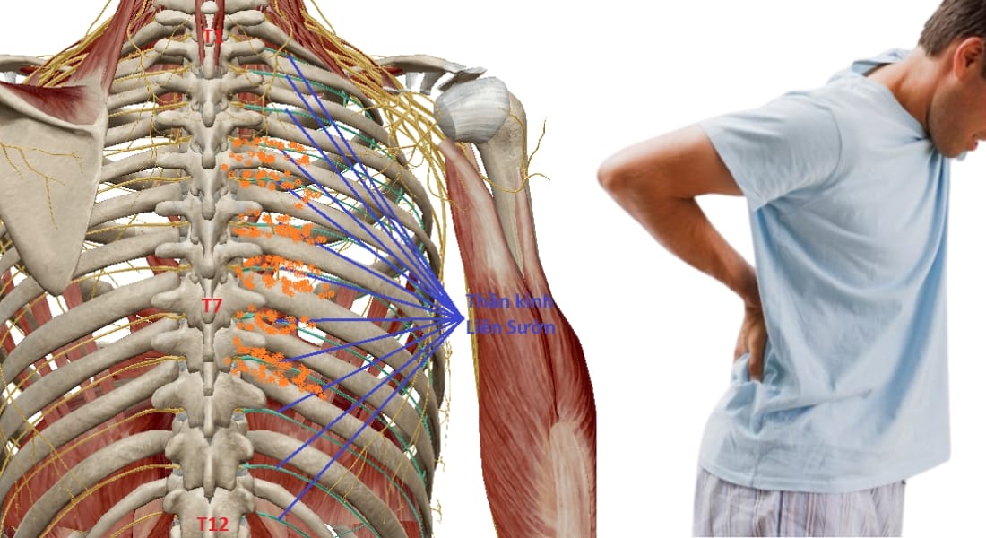 cách chữa đau thần kinh liên sườn