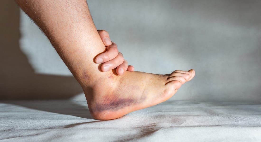 cách chữa sưng mắt cá chân nhanh nhất