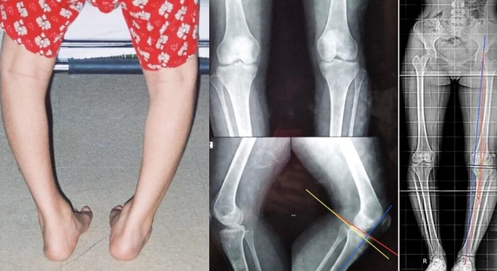 dáng chân vòng kiềng