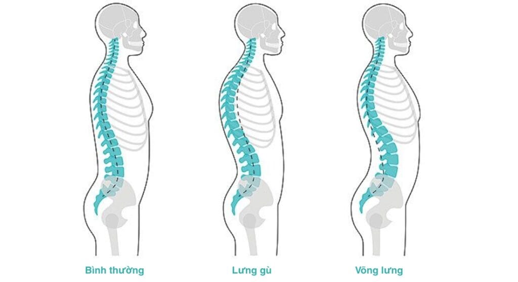 dấu hiệu bị võng lưng