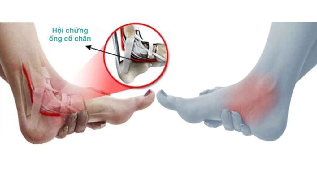 hội chứng ống cổ chân