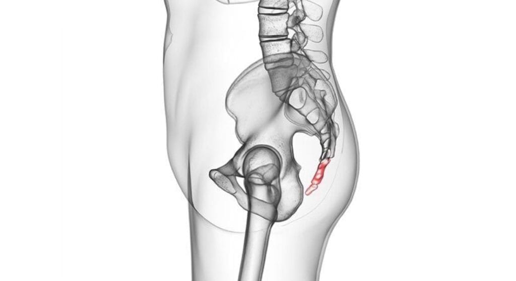 lệch xương cụt