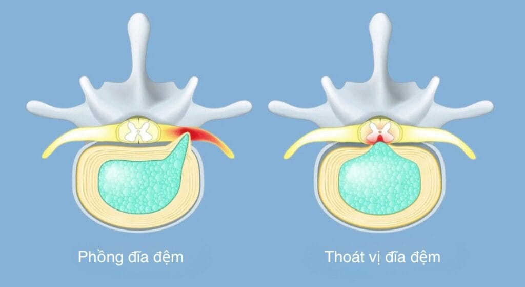 phân biệt phồng đĩa đệm và thoát vị đĩa đệm