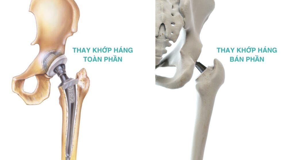 phân loại thay khớp háng