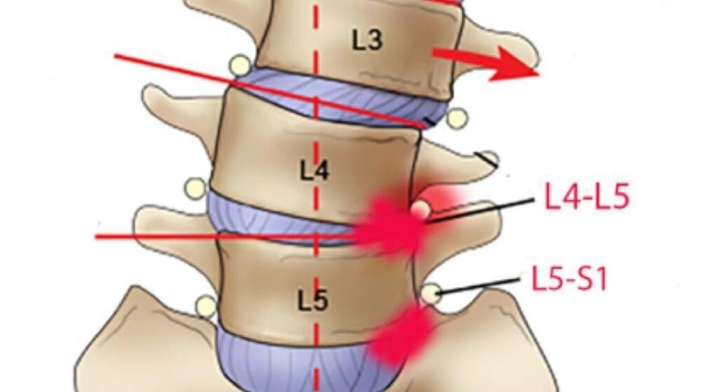 phồng đĩa đệm l4 l5 là gì