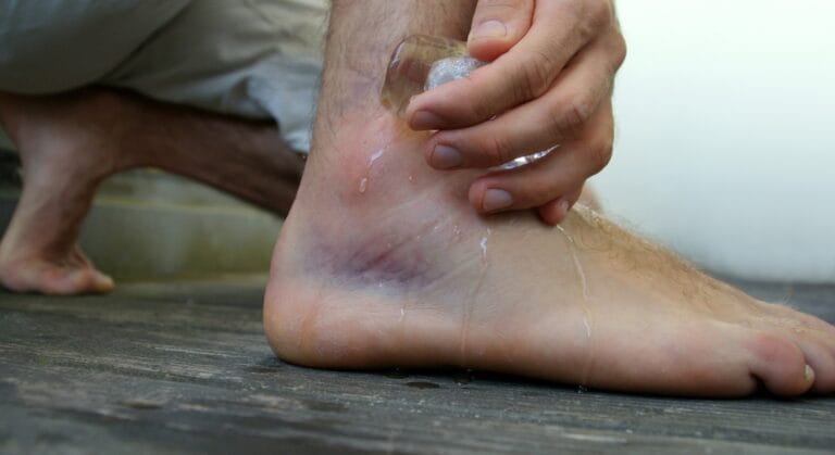 sưng mắt cá chân