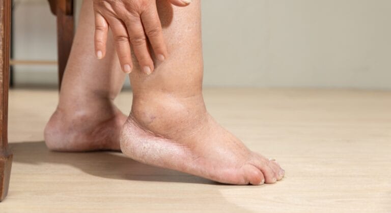 sưng mắt cá chân nhưng không đau