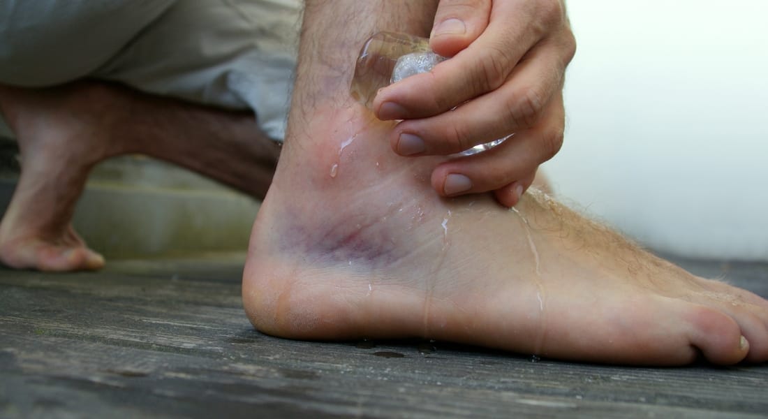 sưng mắt cá chân