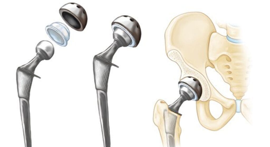 thay khớp háng nhân tạo (1)