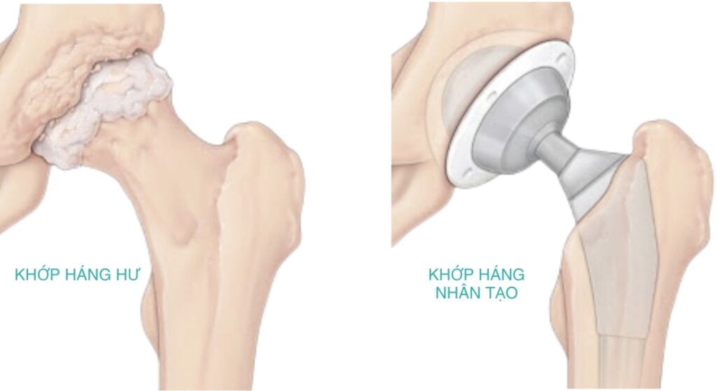 thay khớp háng nhân tạo 