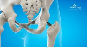 thay khớp háng nhân tạo