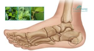 trị gai gót chân bao lâu thì hiệu quả