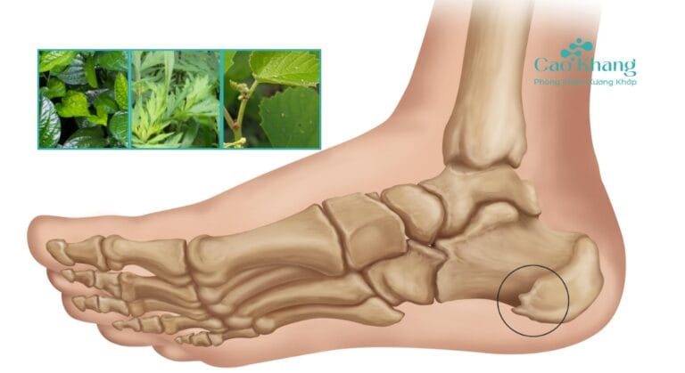 trị gai gót chân bao lâu thì hiệu quả
