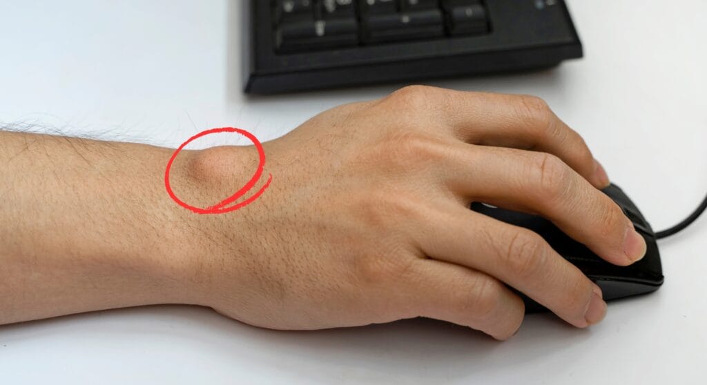 u bao hoạt dịch khớp cổ tay