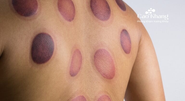 vết bầm tím khi giác hơi