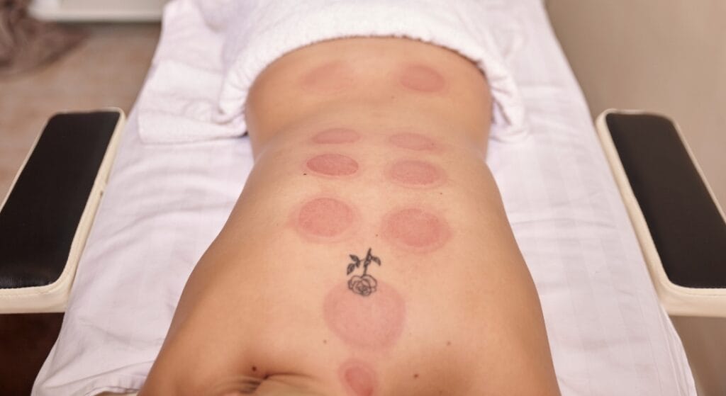 vết bầm tím khi giác hơi