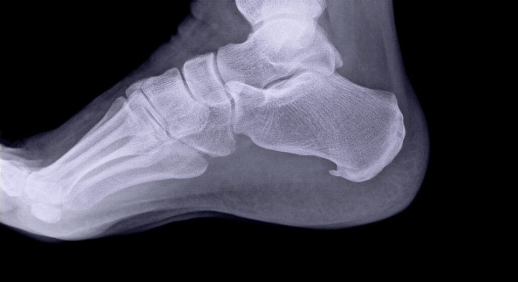 chụp x-quang gót chân