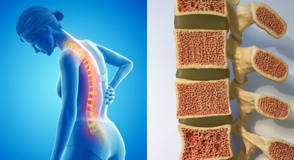 xẹp đốt sống do loãng xương