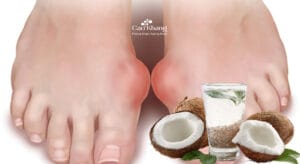 Bệnh gút có uống được nước dừa không