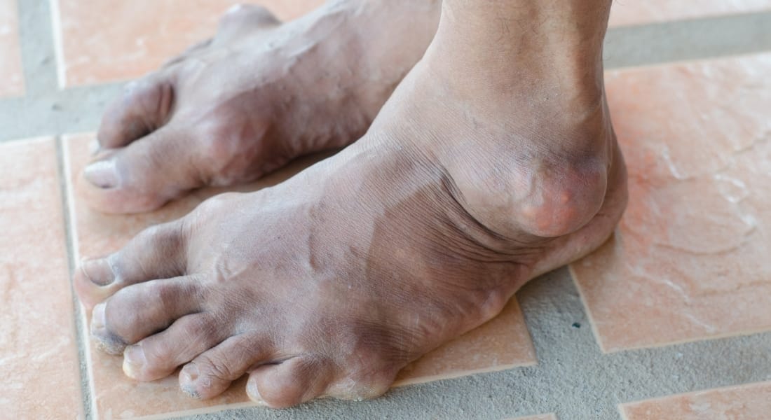 bệnh gút sống được bao lâu