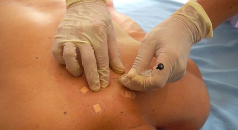 cấy chỉ chữa bệnh xương khớp