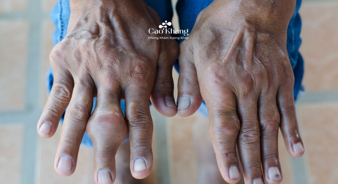 dấu hiệu bệnh gút ở tay