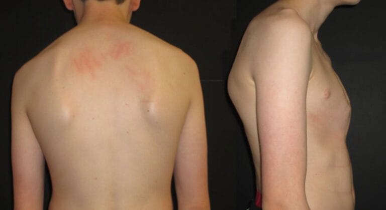 dấu hiệu xương bả vai bị lồi