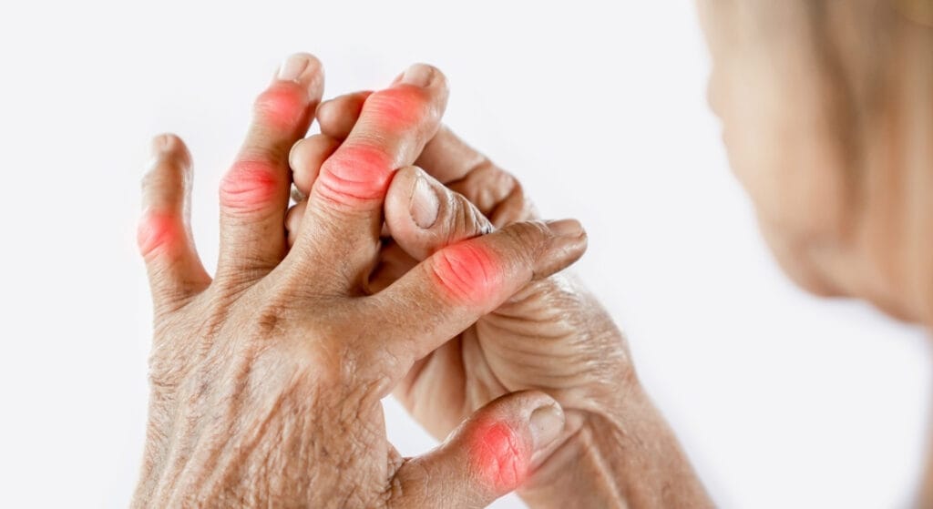 đau sưng đỏ ở tay do gút (1)