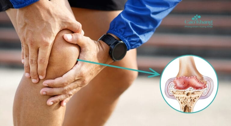 gai khớp gối