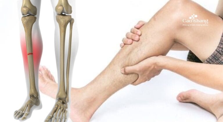 gãy xương ống chân bao lâu mới lành