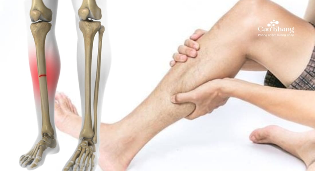 gãy xương ống chân bao lâu mới lành